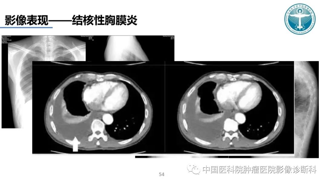 影像PPT - 【PPT】肺结核-54