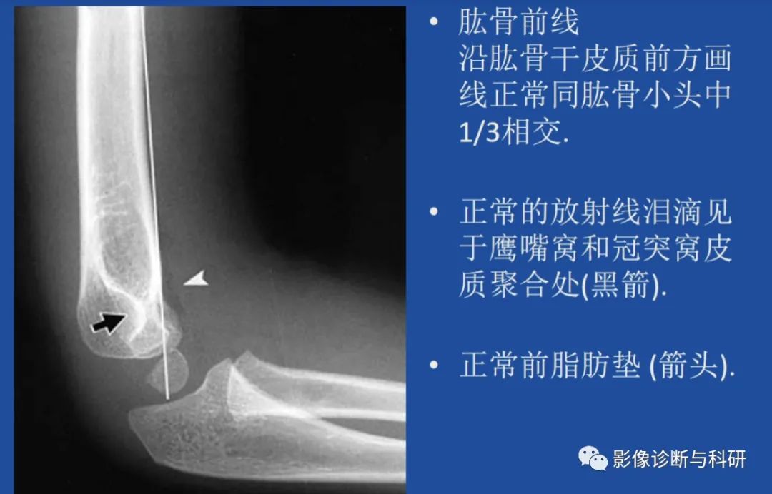 影像PPT - 儿童肘关节脱位的几个关键要点-4 影像PPT - 儿童肘关节脱位的几个关键要点-4