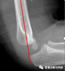 影像PPT - 儿童肘关节脱位的几个关键要点-6 影像PPT - 儿童肘关节脱位的几个关键要点-6