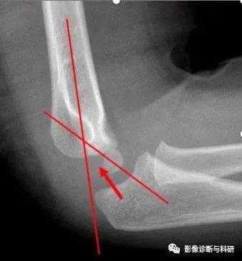 影像PPT - 儿童肘关节脱位的几个关键要点-8 影像PPT - 儿童肘关节脱位的几个关键要点-8