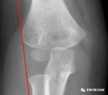 影像PPT - 儿童肘关节脱位的几个关键要点-7 影像PPT - 儿童肘关节脱位的几个关键要点-7