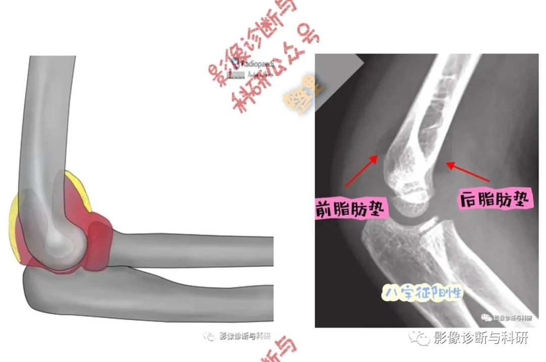 影像PPT - 儿童肘关节脱位的几个关键要点-10 影像PPT - 儿童肘关节脱位的几个关键要点-10
