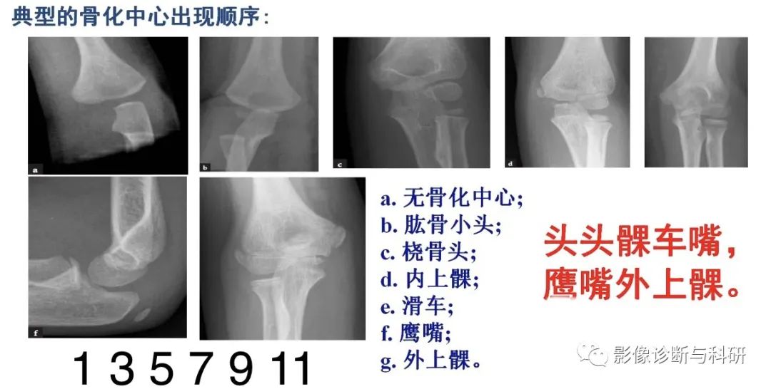 影像PPT - 儿童肘关节脱位的几个关键要点-12 影像PPT - 儿童肘关节脱位的几个关键要点-12