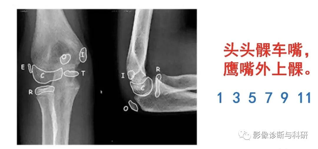 影像PPT - 儿童肘关节脱位的几个关键要点-13 影像PPT - 儿童肘关节脱位的几个关键要点-13