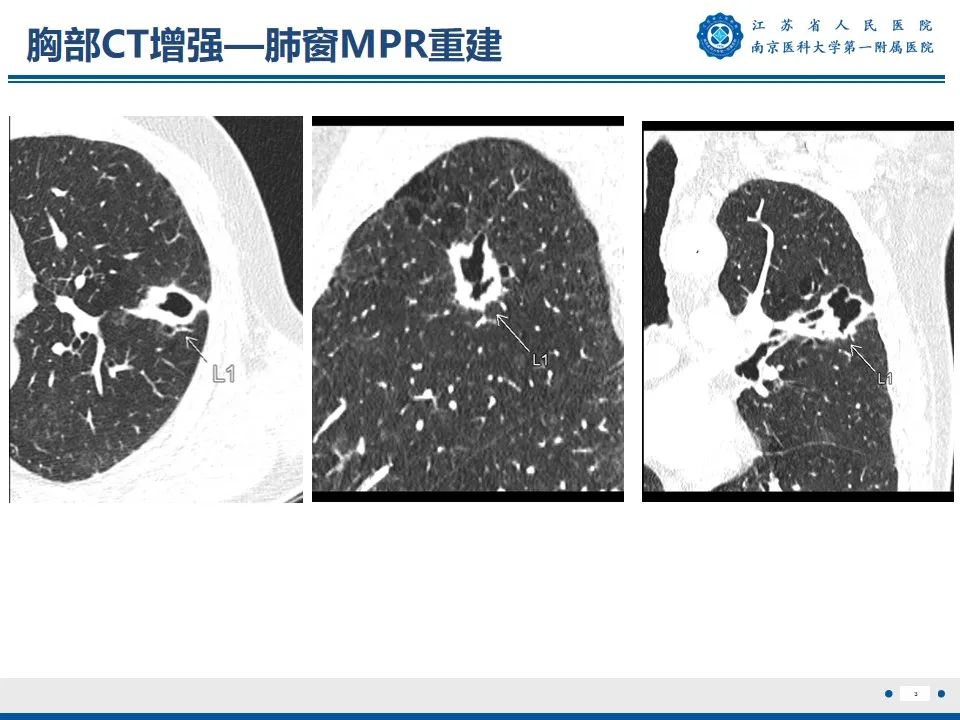 影像PPT - 【PPT】周围型肺鳞癌-4
