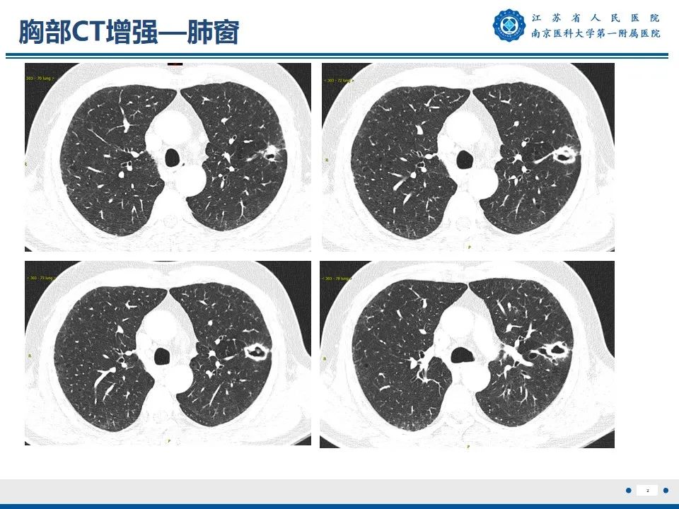 影像PPT - 【PPT】周围型肺鳞癌-3