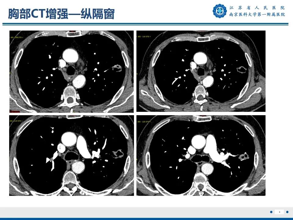 影像PPT - 【PPT】周围型肺鳞癌-5