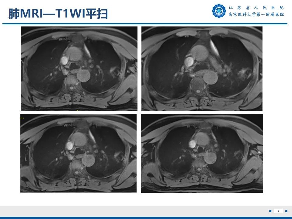 影像PPT - 【PPT】周围型肺鳞癌-7