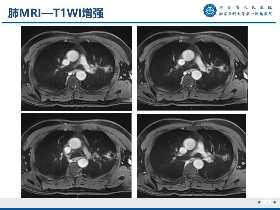 影像PPT - 【PPT】周围型肺鳞癌-9