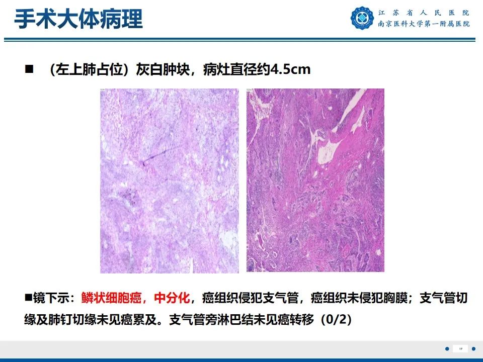影像PPT - 【PPT】周围型肺鳞癌-18