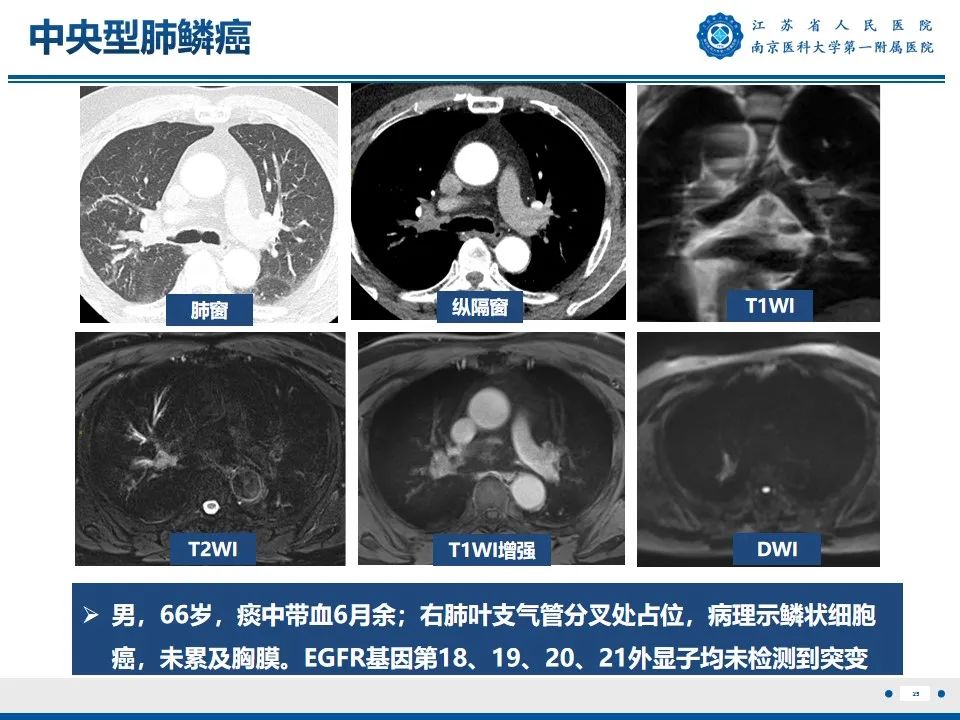 影像PPT - 【PPT】周围型肺鳞癌-26