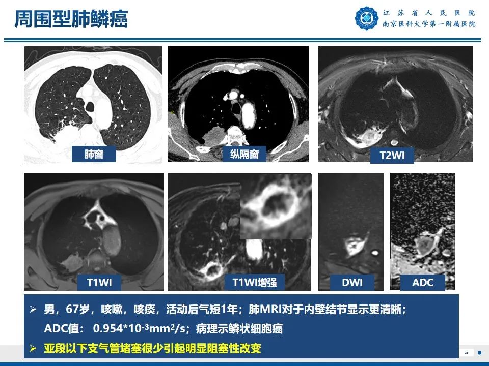 影像PPT - 【PPT】周围型肺鳞癌-27