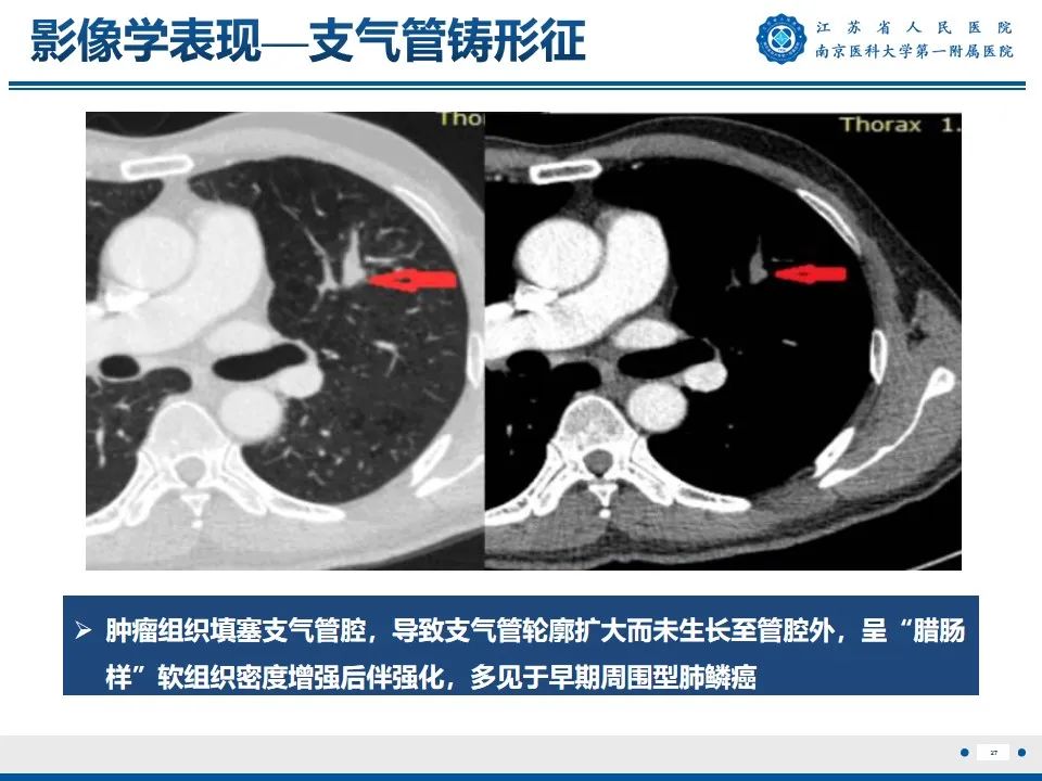 影像PPT - 【PPT】周围型肺鳞癌-28
