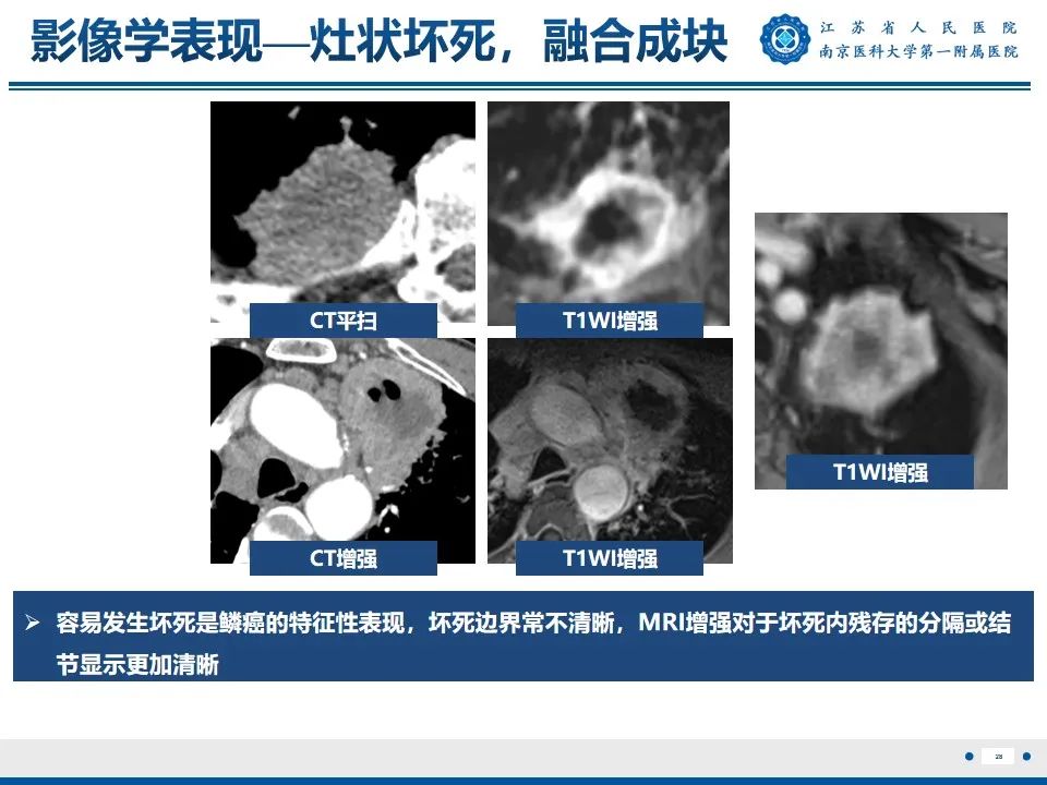 影像PPT - 【PPT】周围型肺鳞癌-29