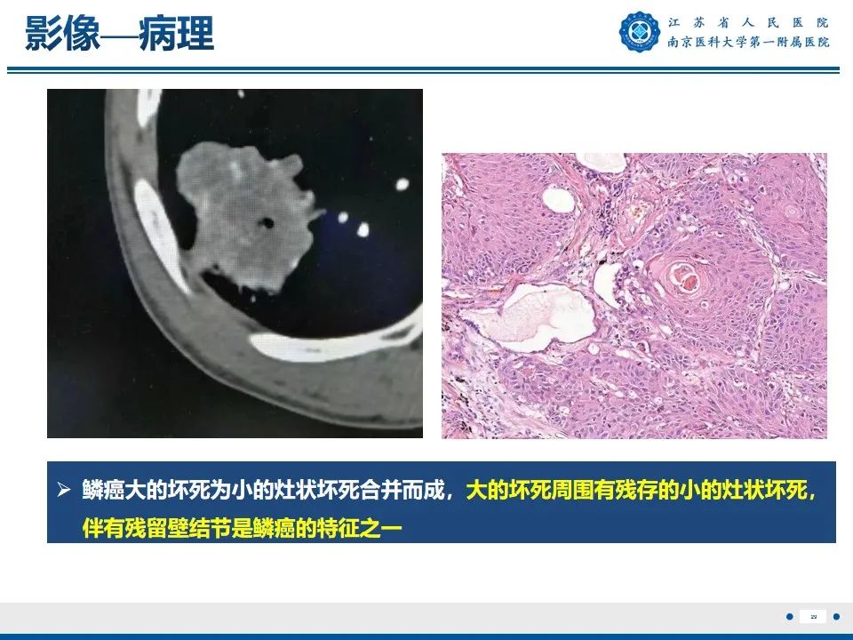 影像PPT - 【PPT】周围型肺鳞癌-30