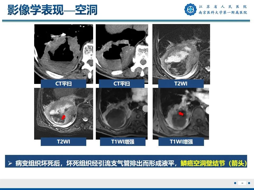 影像PPT - 【PPT】周围型肺鳞癌-31