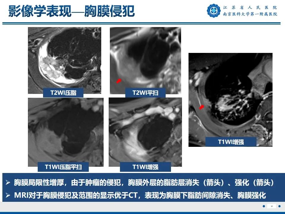 影像PPT - 【PPT】周围型肺鳞癌-32