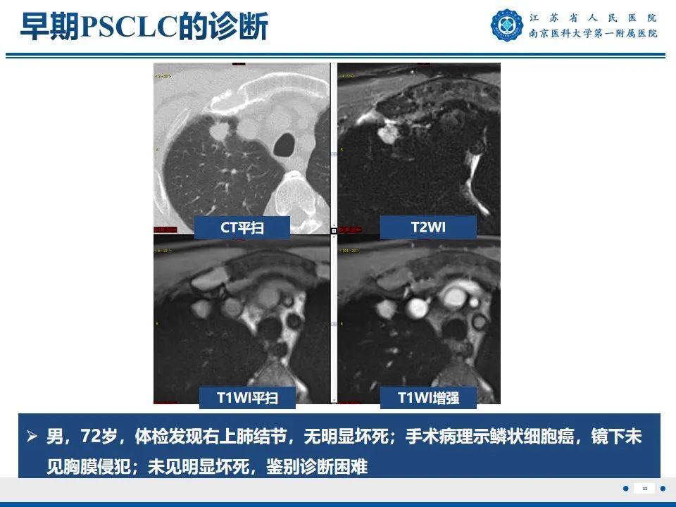 影像PPT - 【PPT】周围型肺鳞癌-33