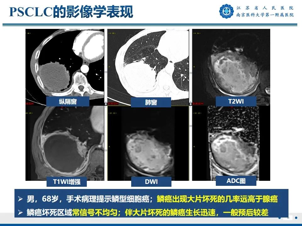 影像PPT - 【PPT】周围型肺鳞癌-34