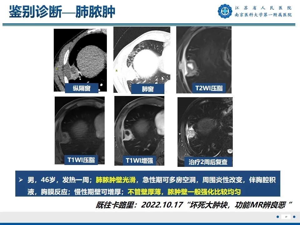 影像PPT - 【PPT】周围型肺鳞癌-38