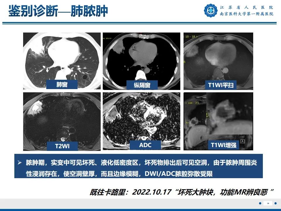 影像PPT - 【PPT】周围型肺鳞癌-39