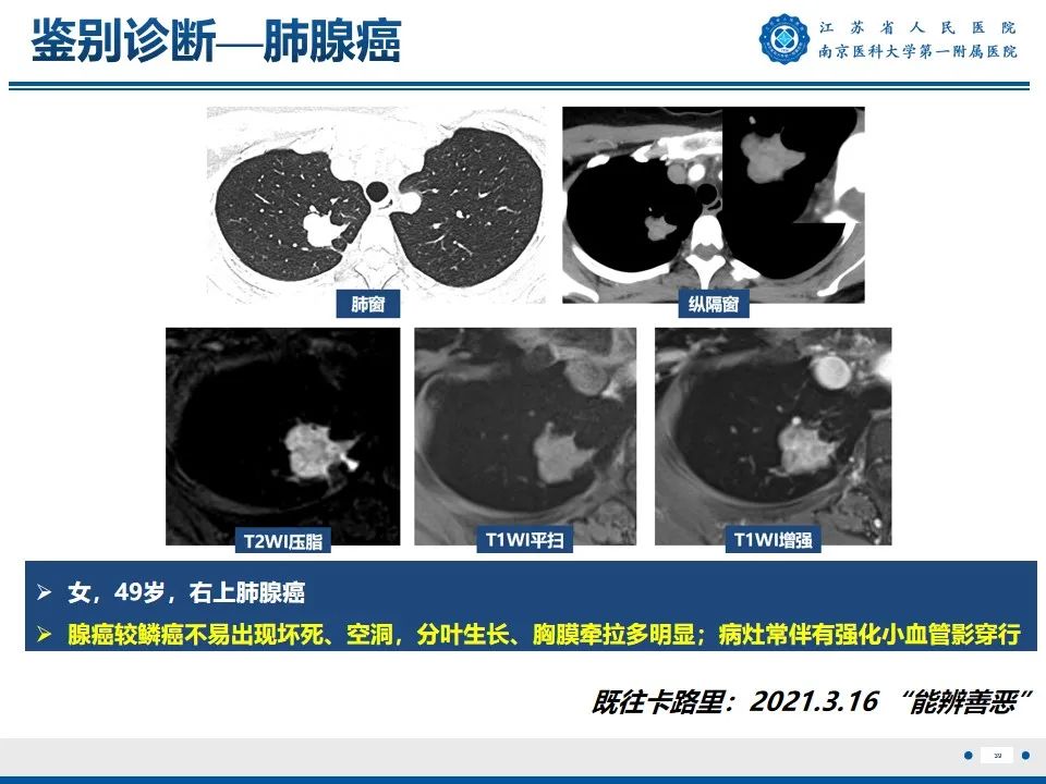 影像PPT - 【PPT】周围型肺鳞癌-40