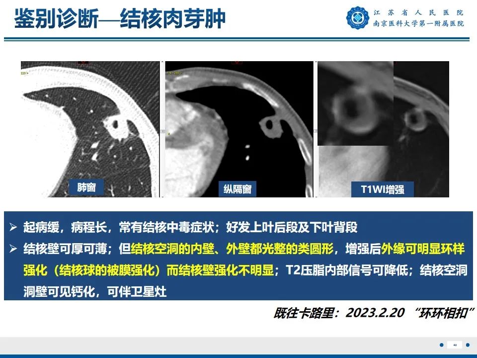 影像PPT - 【PPT】周围型肺鳞癌-41