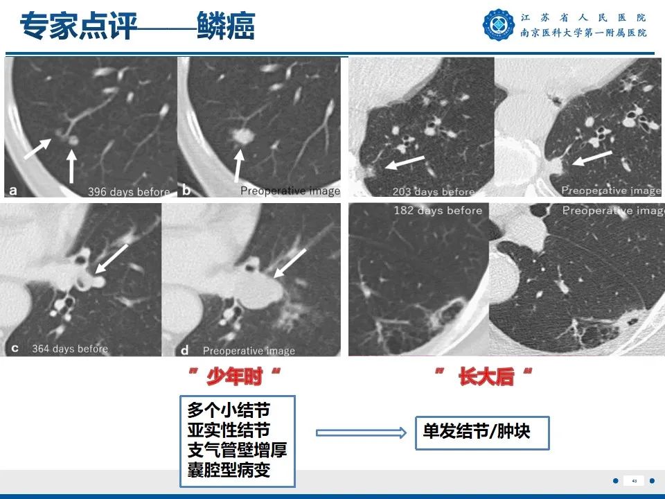 影像PPT - 【PPT】周围型肺鳞癌-44