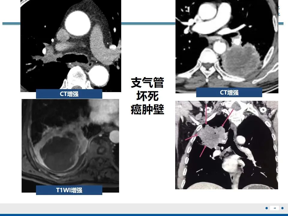 影像PPT - 【PPT】周围型肺鳞癌-46