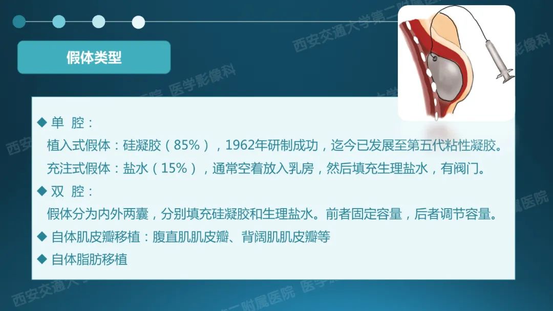影像PPT - 【PPT】乳腺假体植入的MRI评估-4