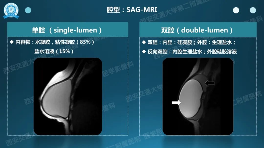 影像PPT - 【PPT】乳腺假体植入的MRI评估-5