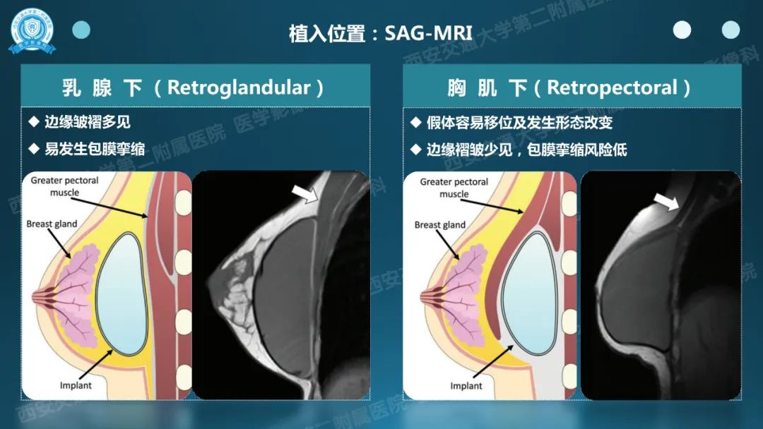 影像PPT - 【PPT】乳腺假体植入的MRI评估-6