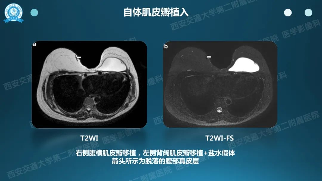 影像PPT - 【PPT】乳腺假体植入的MRI评估-7