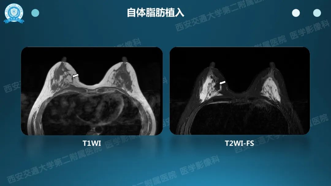 影像PPT - 【PPT】乳腺假体植入的MRI评估-8