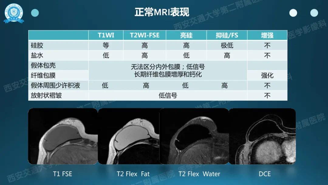 影像PPT - 【PPT】乳腺假体植入的MRI评估-11