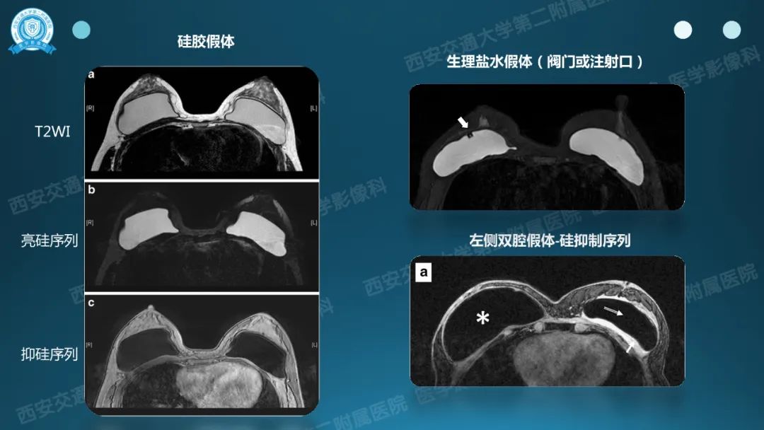 影像PPT - 【PPT】乳腺假体植入的MRI评估-12