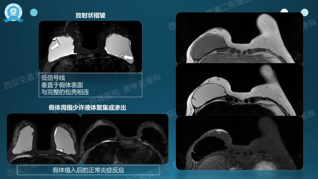 影像PPT - 【PPT】乳腺假体植入的MRI评估-13