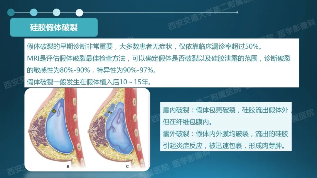 影像PPT - 【PPT】乳腺假体植入的MRI评估-17
