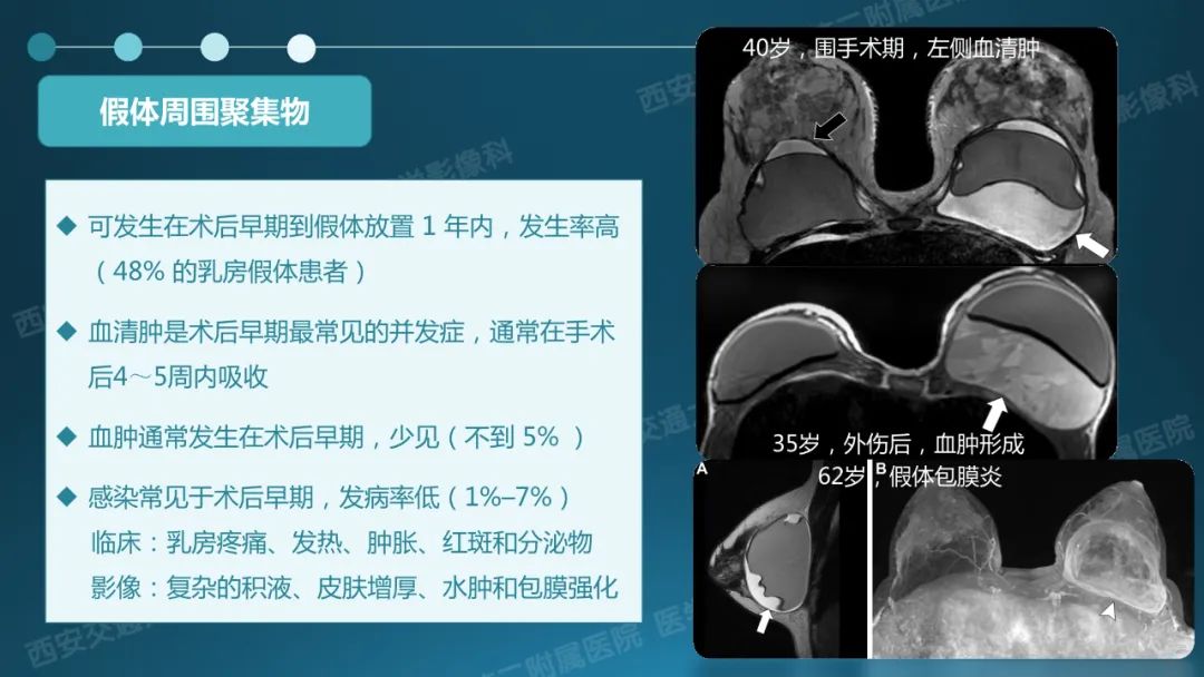 影像PPT - 【PPT】乳腺假体植入的MRI评估-16