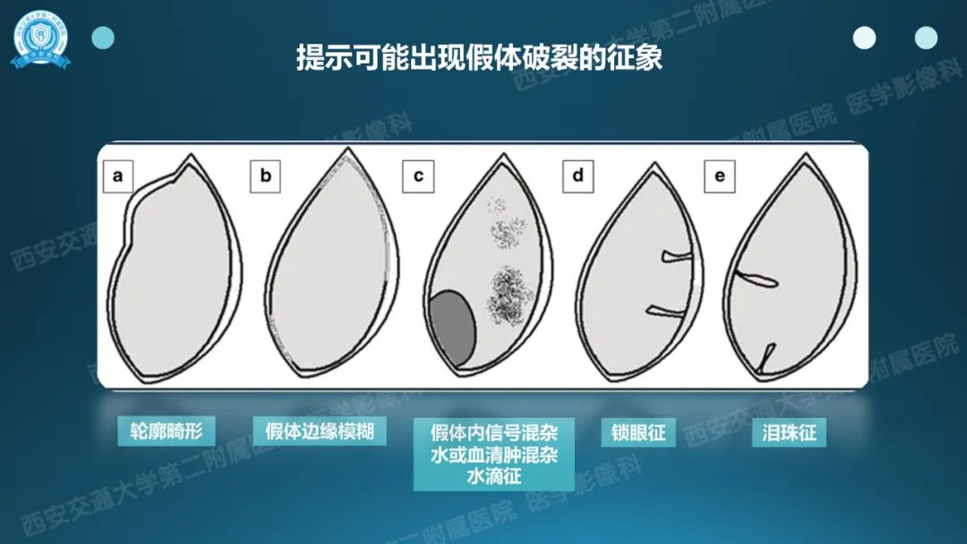 影像PPT - 【PPT】乳腺假体植入的MRI评估-18