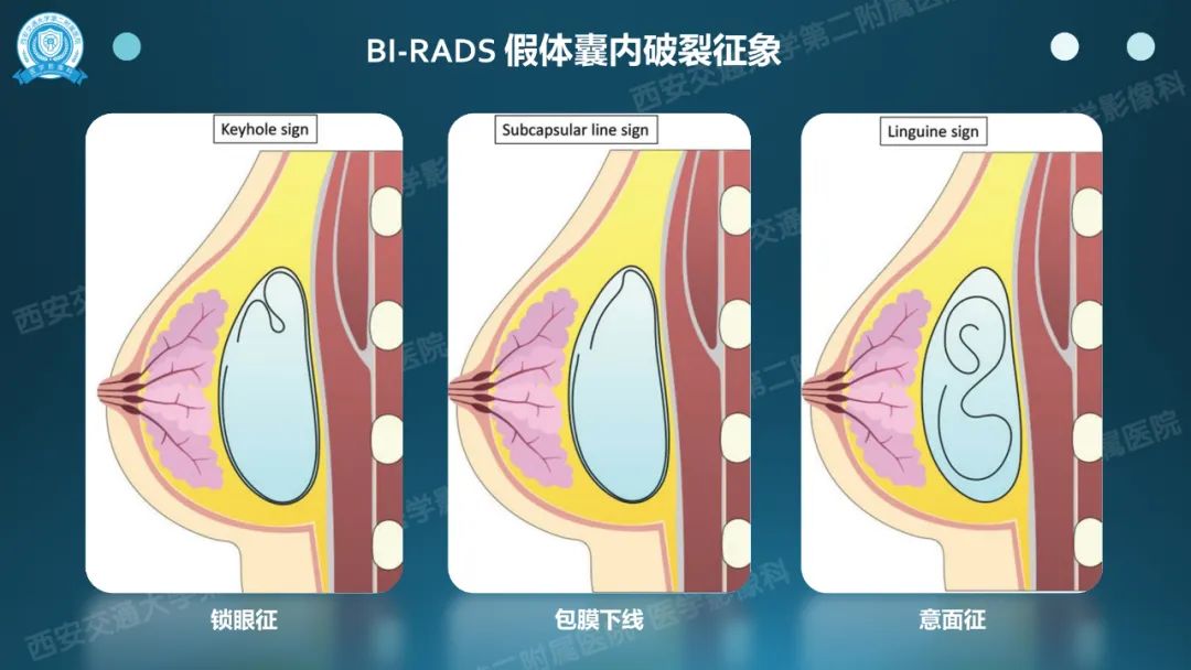 影像PPT - 【PPT】乳腺假体植入的MRI评估-19