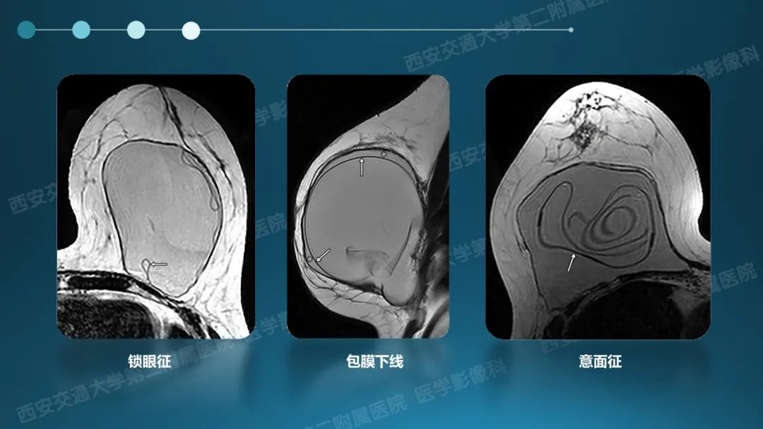 影像PPT - 【PPT】乳腺假体植入的MRI评估-20