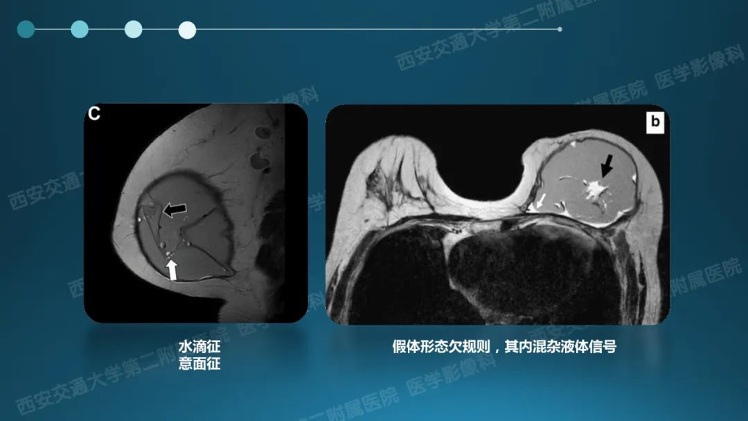 影像PPT - 【PPT】乳腺假体植入的MRI评估-22