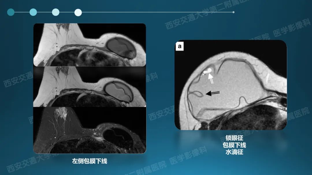 影像PPT - 【PPT】乳腺假体植入的MRI评估-21
