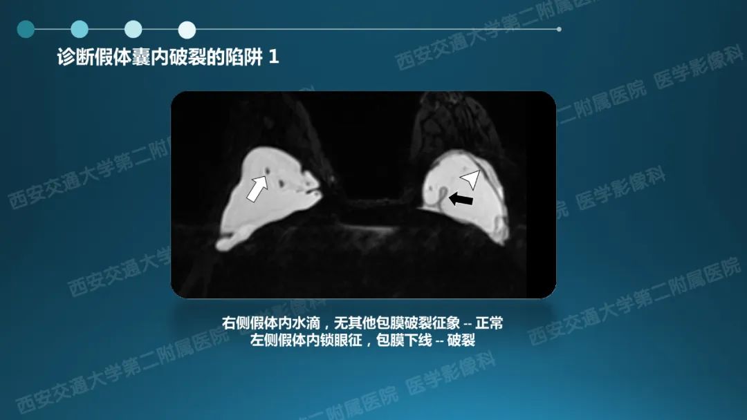 影像PPT - 【PPT】乳腺假体植入的MRI评估-23