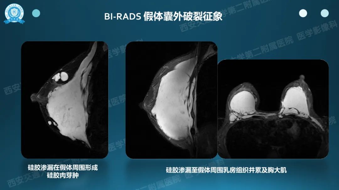 影像PPT - 【PPT】乳腺假体植入的MRI评估-25
