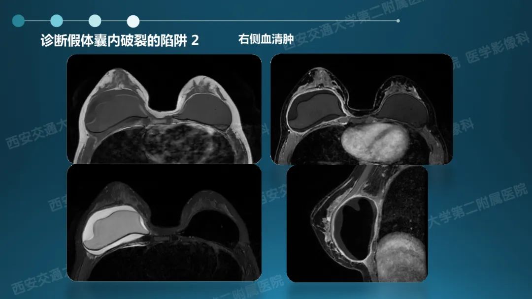 影像PPT - 【PPT】乳腺假体植入的MRI评估-24