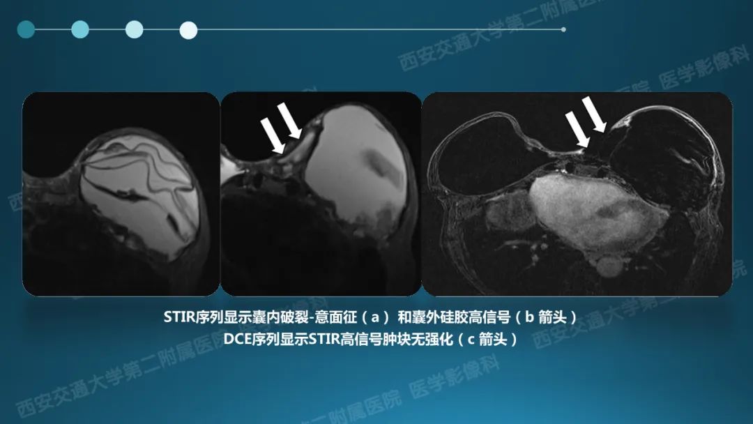 影像PPT - 【PPT】乳腺假体植入的MRI评估-26