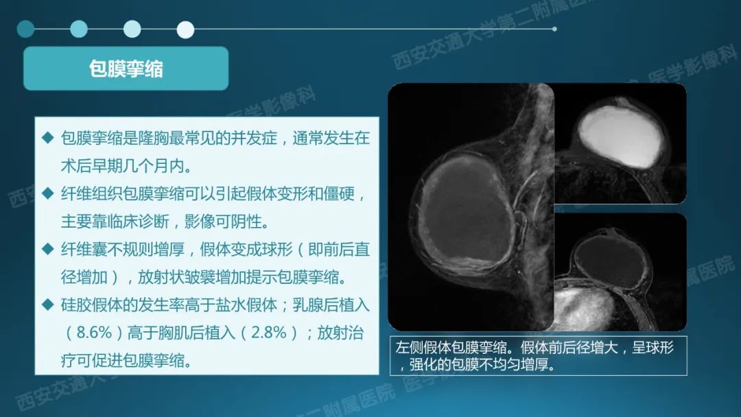影像PPT - 【PPT】乳腺假体植入的MRI评估-27