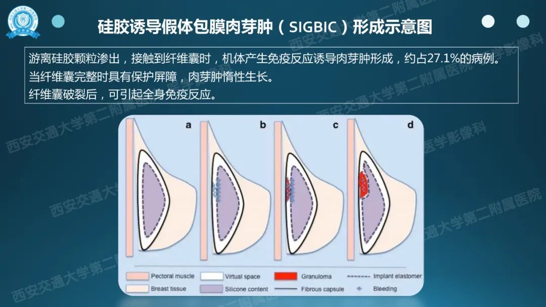 影像PPT - 【PPT】乳腺假体植入的MRI评估-28